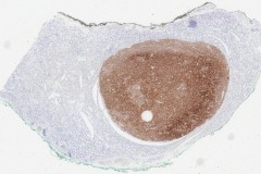Non-invasive follicular thyroid neoplasm with papillary-like nuclear features: Immunohistochemistry for HBME-1