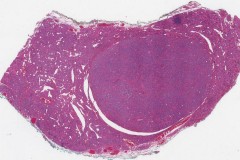 Non-invasive follicular thyroid neoplasm with papillary-like nuclear features