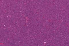 Oncocytic type noninvasive follicular thyroid neoplasm with papillary-like nuclear features (NIFTP)