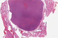 Oncocytic type noninvasive follicular thyroid neoplasm with papillary-like nuclear features (NIFTP)