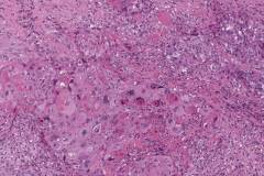 HPV-associated keratinizing squamous cell carcinoma of the oropharynx