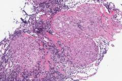 Non-necrotizing granulomatous lymphadenitis