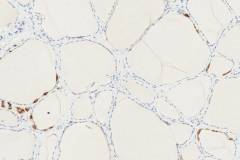 C cells in the thyroid gland: Immunohistochemistry for chromogranin