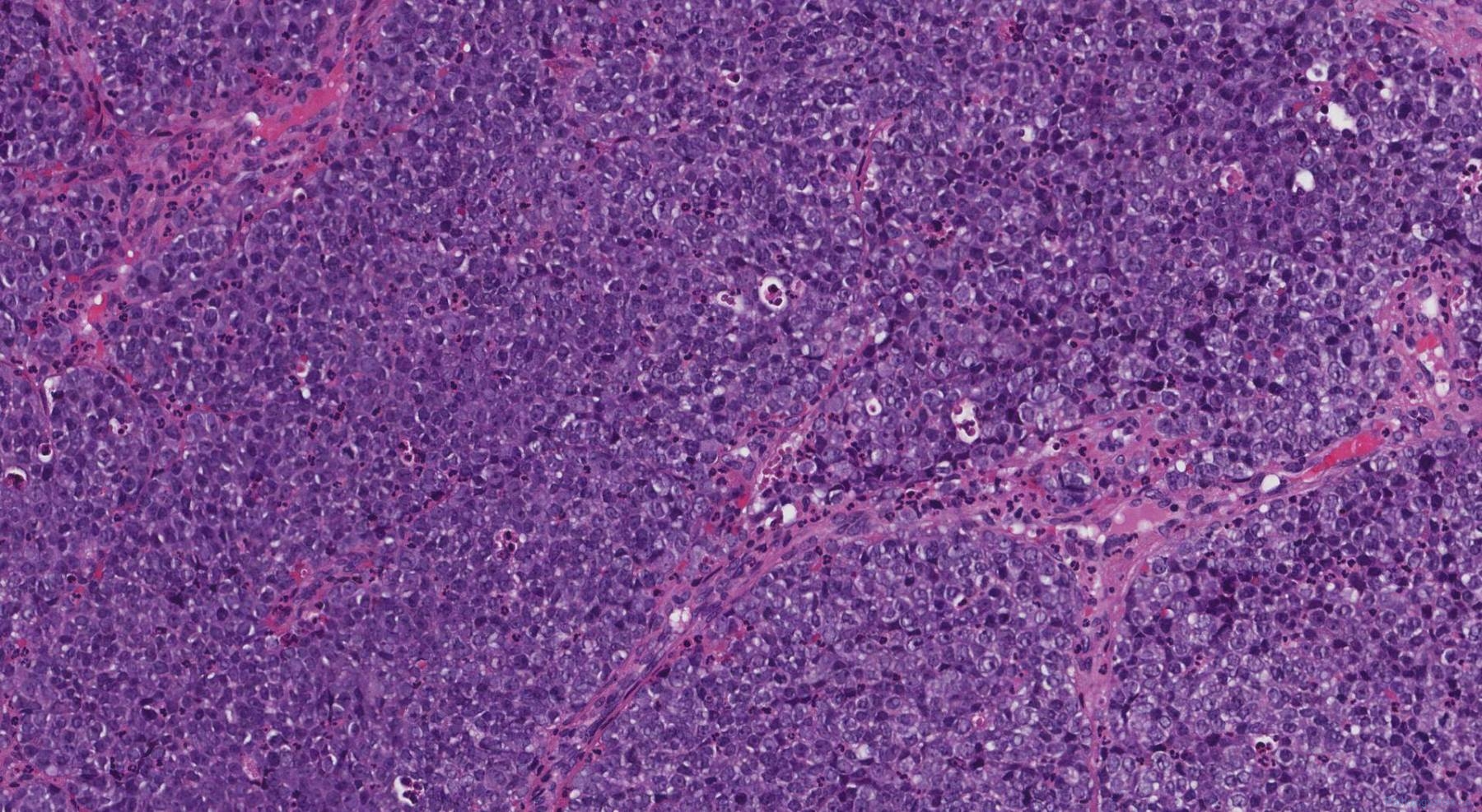 metastatic nut carcinoma icd 9