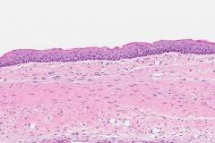 Odontogenic keratocyst