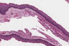 Odontogenic keratocyst