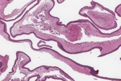 Odontogenic keratocyst