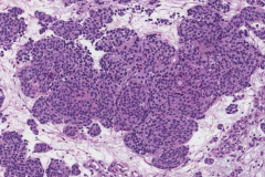 Olfactory neuroblastoma
