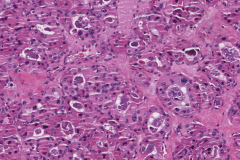 Oncocytic adenoma of the thyroid gland