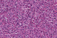 Oncocytic adenoma of the thyroid gland