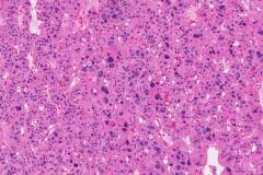 Oncocytic carcinoma of the thyroid gland