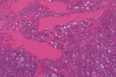 Oncocytic carcinoma of the thyroid gland