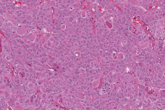 Oncocytic carcinoma of the thyroid gland