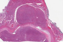 Oncocytic carcinoma of the thyroid gland