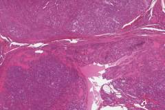 Oncocytic carcinoma of the thyroid gland