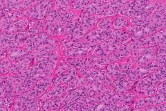 Oncocytic carcinoma of the thyroid gland