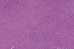 Oncocytic carcinoma of the thyroid gland