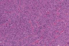 Oncocytic carcinoma of the thyroid gland
