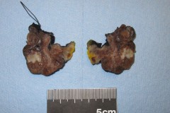 Oncocytic carcinoma of the thyroid gland