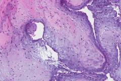 Papillary fibroelastoma