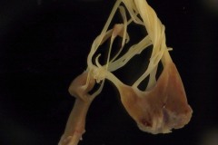 Mitral valve papillary muscle rupture