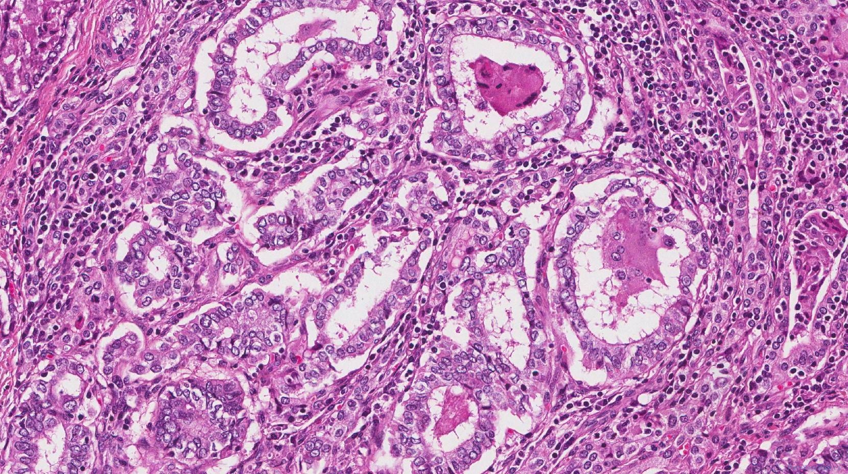 papillary carcinoma of thyroid metastasis