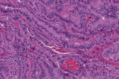 Tall cell variant papillary thyroid carcinoma