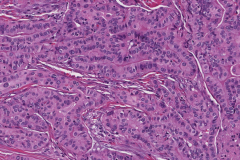 Tall cell variant papillary thyroid carcinoma