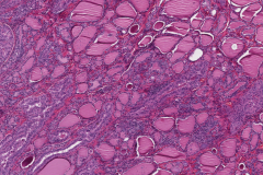Tall cell variant papillary thyroid carcinoma