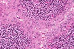 Warthin-like variant papillary thyroid carcinoma