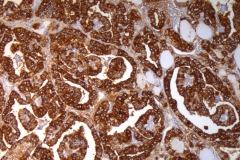 Papillary thyroid carcinoma