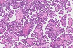 Classic variant papillary thyroid carcinoma