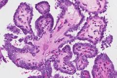 Classic variant papillary thyroid carcinoma