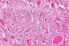 Classic variant papillary thyroid carcinoma