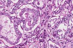 Classic variant papillary thyroid carcinoma