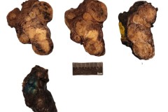 Classic variant papillary thyroid carcinoma in a background of nodular follicular disease