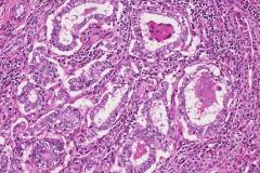 Classic variant papillary thyroid carcinoma