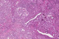 Classic variant papillary thyroid carcinoma