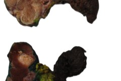 Classic variant papillary thyroid carcinoma