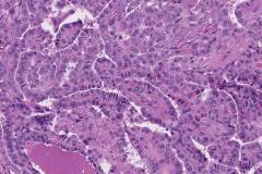 Classic variant papillary thyroid carcinoma