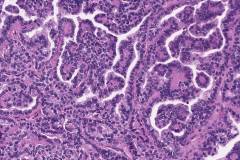 Columnar variant papillary thyroid carcinoma