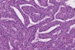 Tall cell variant papillary thyroid carcinoma
