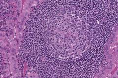 Warthin-like variant papillary thyroid carcinoma