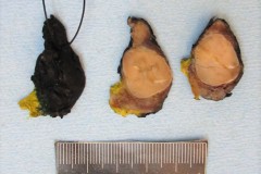 Minimally invasive encapsulated follicular variant papillary thyroid carcinoma
