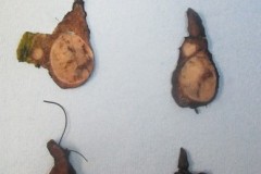 Noninvasive follicular thyroid neoplasm with papillary-like nuclear features (NIFTP) and classic variant papillary thyroid carcinoma