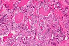 Classic variant papillary thyroid carcinoma