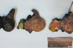 Papillary thyroid carcinoma arising from a background of nodular follicular disease