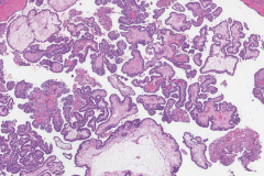 Classic variant papillary thyroid carcinoma
