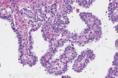 Classic variant papillary thyroid carcinoma