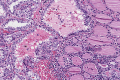 Classic variant papillary thyroid carcinoma